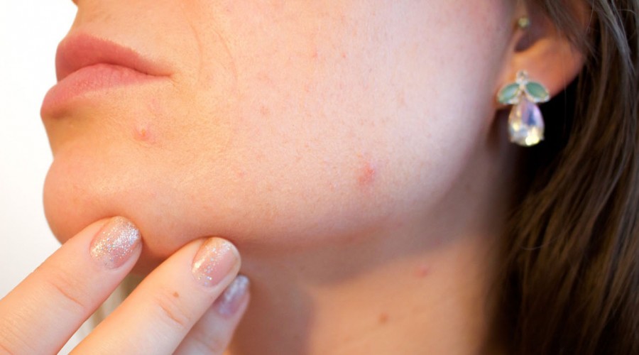 #5TipsLive: Dermatóloga explica qué hacer para evitar la aparición de granitos en cuarentena