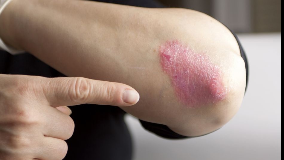 Nuevo medicamento para la Psoriasis logra borrar el 90% de las manchas en la piel Nuevo medicamento para la Psoriasis logra borrar el 90% de las manchas en la piel