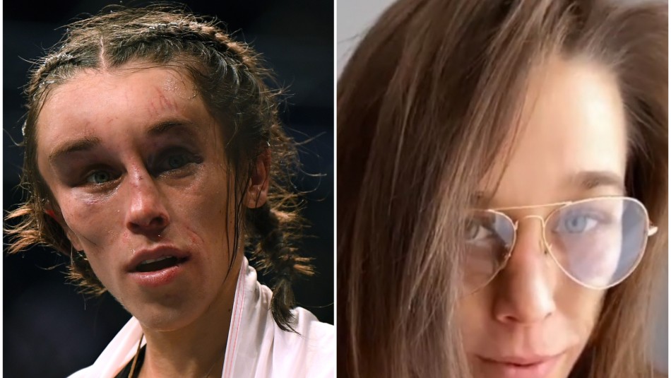 La increíble recuperación de la luchadora de la UFC tras pelea que desfiguró su rostro