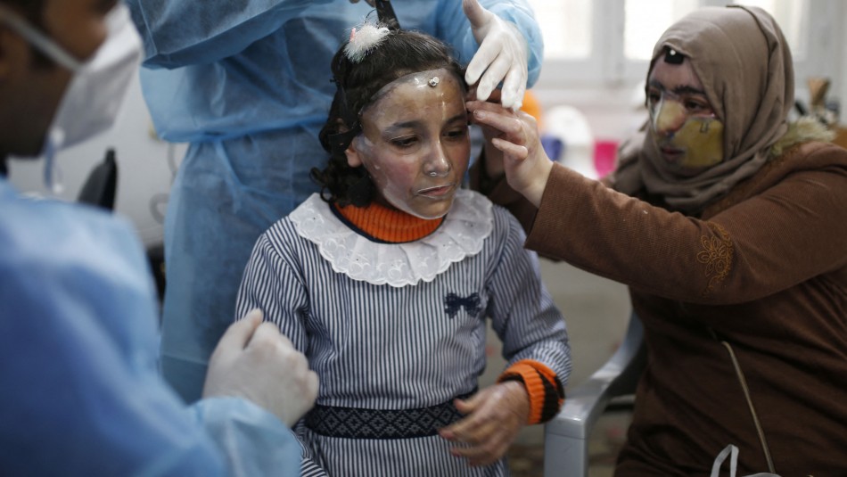 Máscara 3D. Máscaras impresas en 3D se usan para curar rostros quemados en Gaza