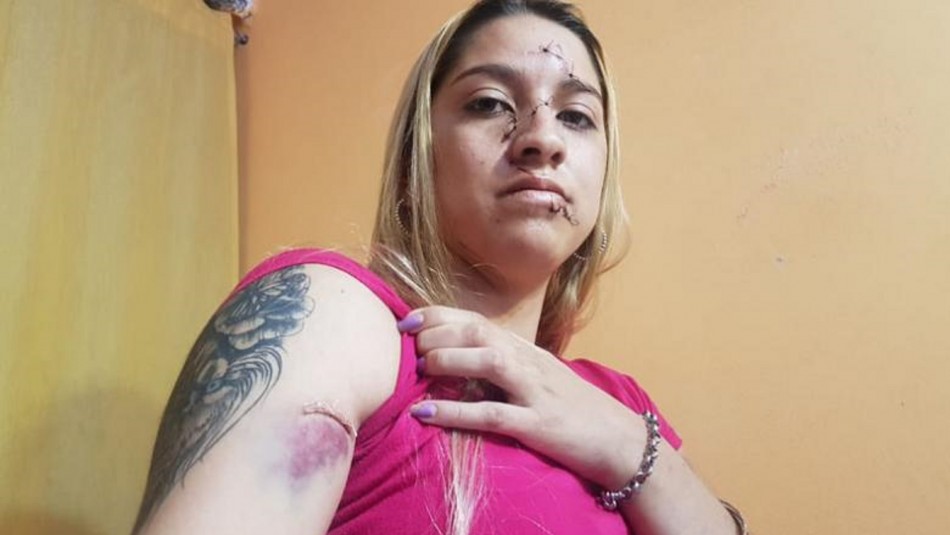 Melissa El Doce Brutal ataque en fiesta clandestina: desfiguraron la cara a una adolescente con una botella