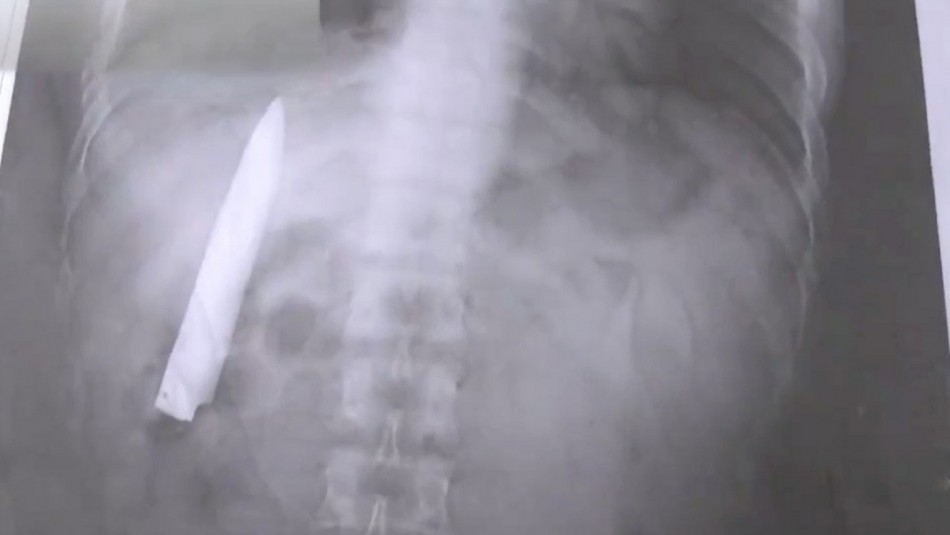 Cuchillo Hombre vive hace 14 meses con un cuchillo en s torso.