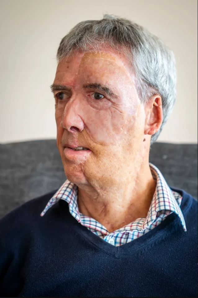 Con la prótesis facial / Crédito: SWNS