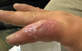 El caso de Mycoplasma phocimorsus contagiada por un oso. / CDC.