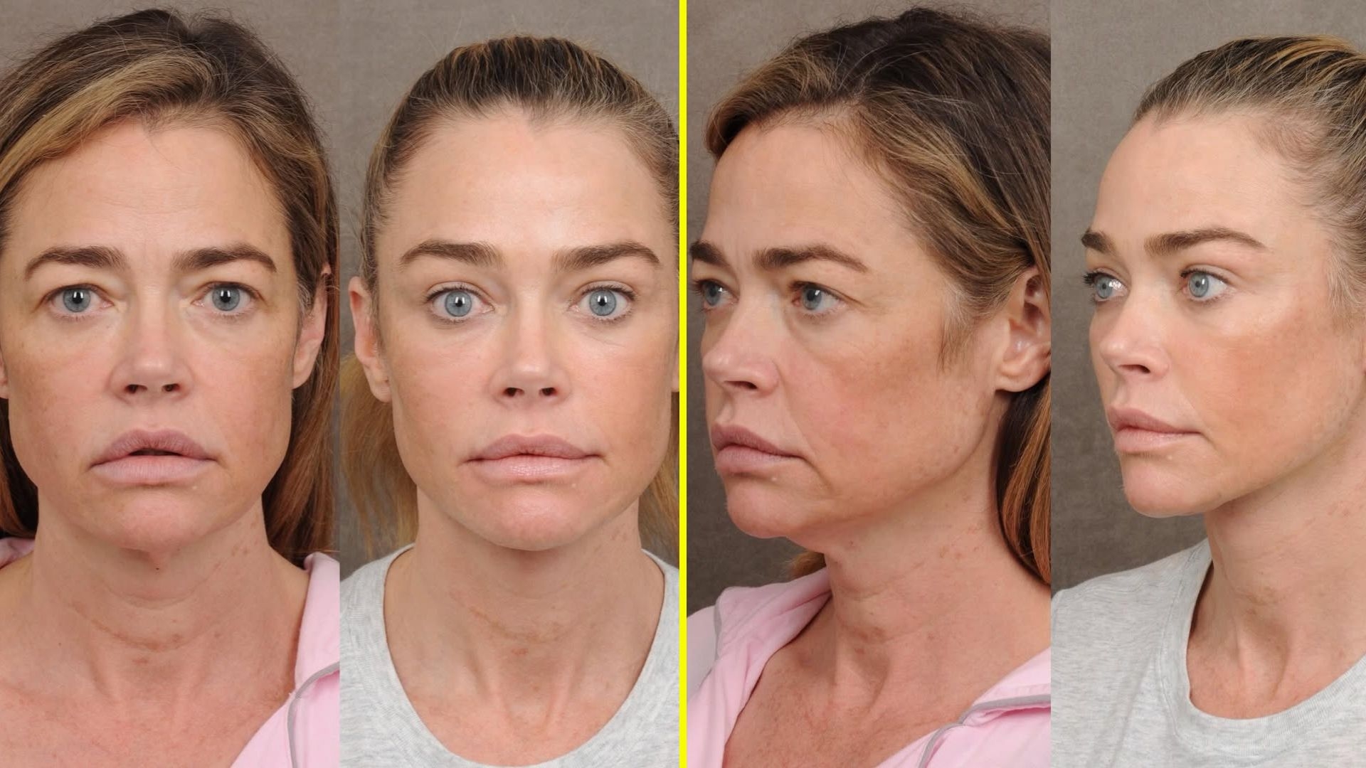 El antes y después de Denise Richards. / @drbentalei